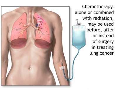 chemotherapy picture