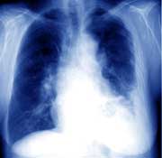 Mesothelioma lung picture