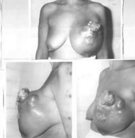 picture image breast cancer